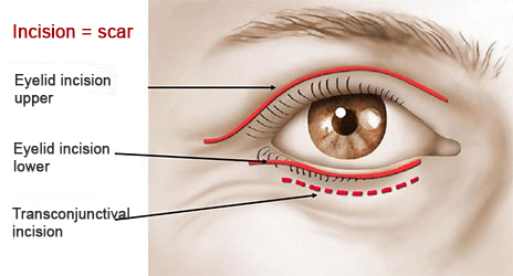 upper eyelid surgery tunisia